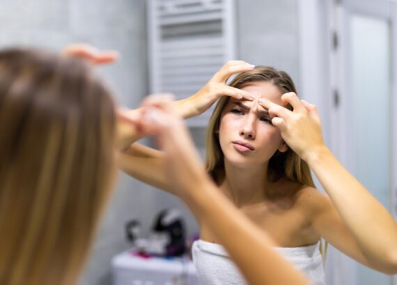 痘痘治療怎麼做？醫師教你消痘痘、治療痘痘處理最有效5大方式