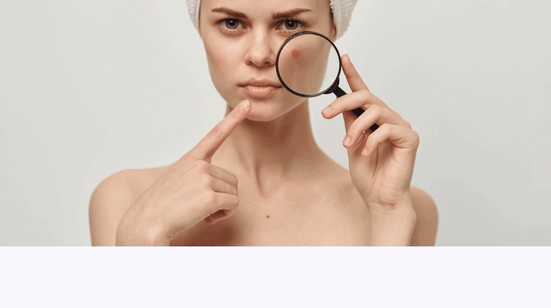 成人痘、痘痘是什麼?一篇搞懂痘痘類型、成因跟解法