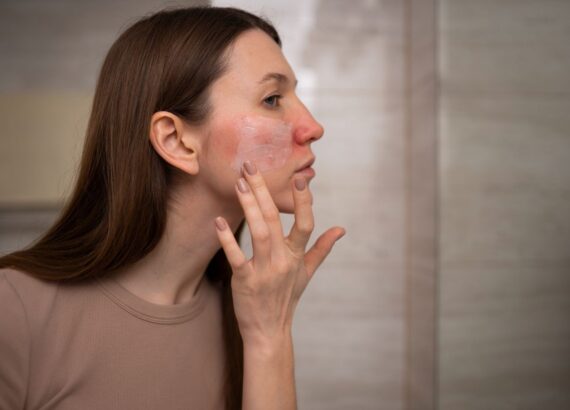 痤瘡是什麼?皮膚科醫師教你正確痤瘡治療、保養、預防